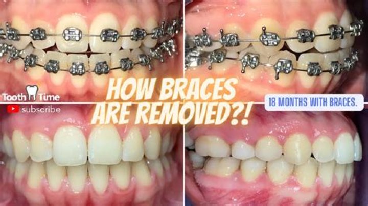 What's the longest someone can have braces?