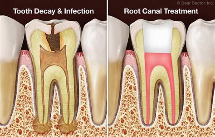 When is it too late for root canal?