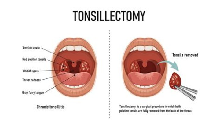 When should you get your tonsils removed?