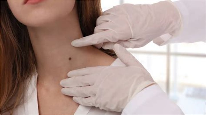 When should you start worrying about a mole?