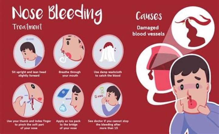 When should you worry about a nosebleed?