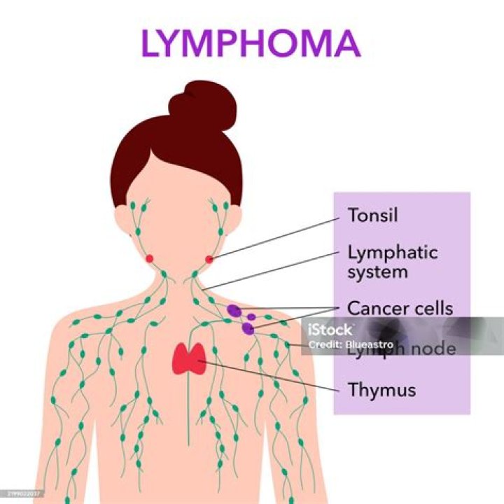 Where does lymphoma usually start?
