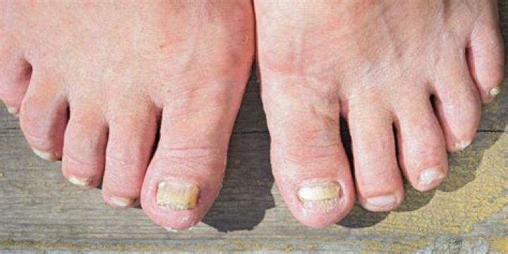 Where does toenail fungus come from?