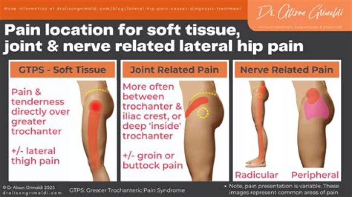 Where is nerve pain felt?