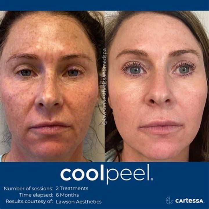 Which is better microneedling or chemical peel?