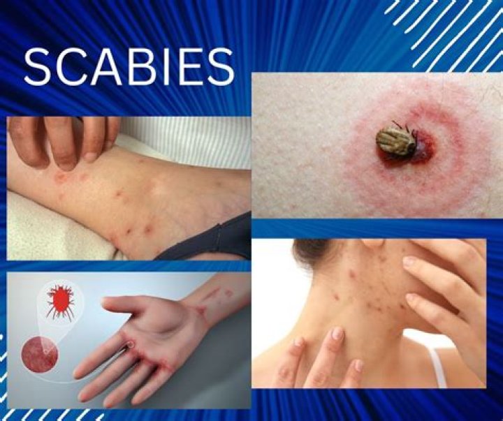 Which is the most common symptom of a scabies infestation?