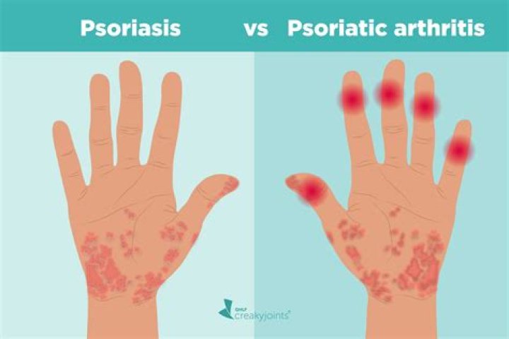 Which is worse RA or psoriatic arthritis?