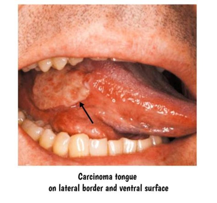 Which is worse sarcoma or carcinoma?