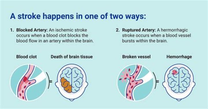 Which side is worse for a stroke?