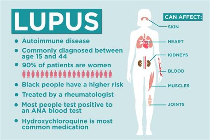 Who is most at risk for lupus?