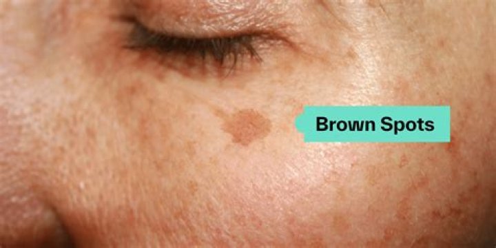 Why am I getting brown spots on my body?