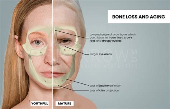 Why am I losing bone in my mouth?