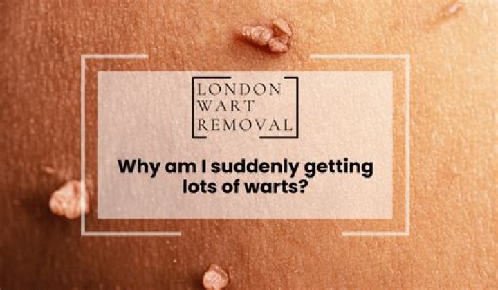 Why am I suddenly getting warts?