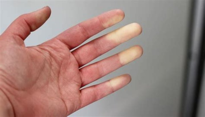 Why are my fingers turning white?