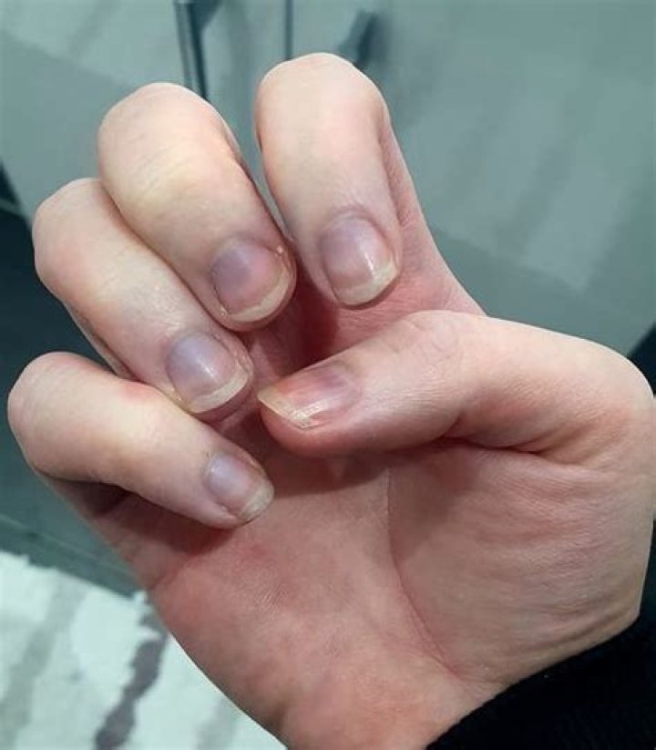 Why are my nails GREY?