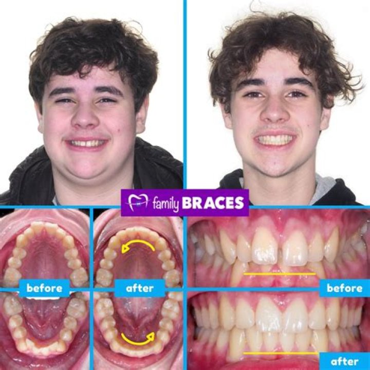 Why are my teeth not perfect after braces?