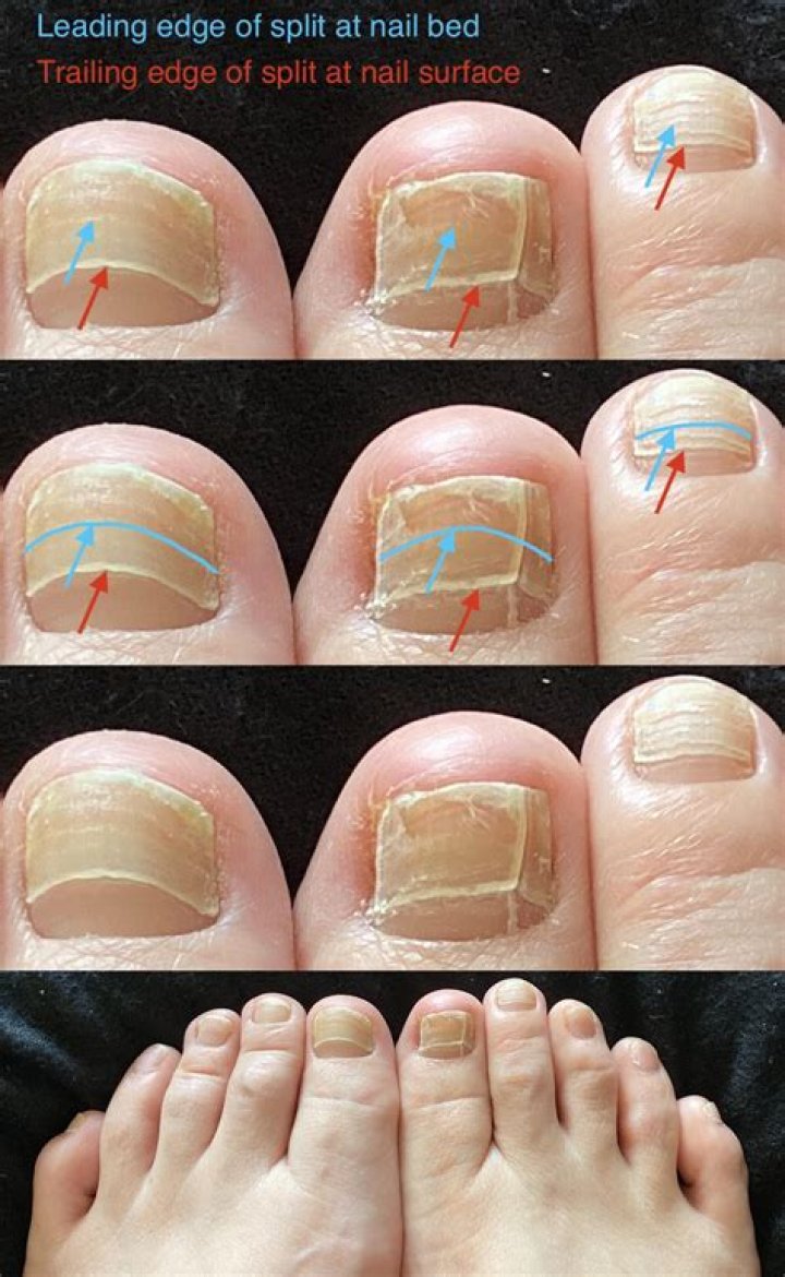 Why are my toenails cracking?