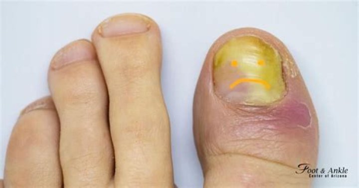 Why are my toenails yellow?