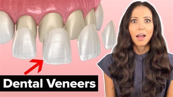 Why are my veneers so white?