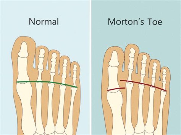 Why do big toes hurt?