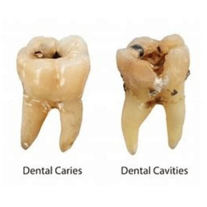 Why do I always have cavities?