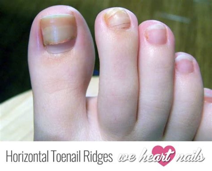 Why do I have double toenails?