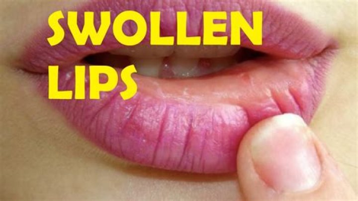 Why do lips swell after kissing?