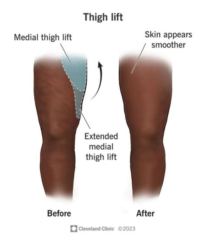 Why do my thighs hurt after cycling?