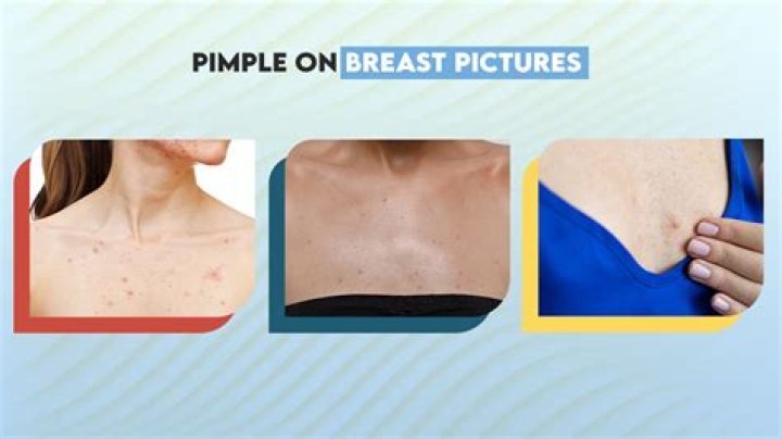 Why do pimples refill?