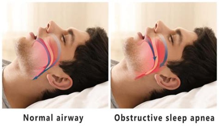 Why do so many veterans have sleep apnea?