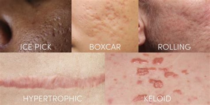 Why do Spartans have scars?