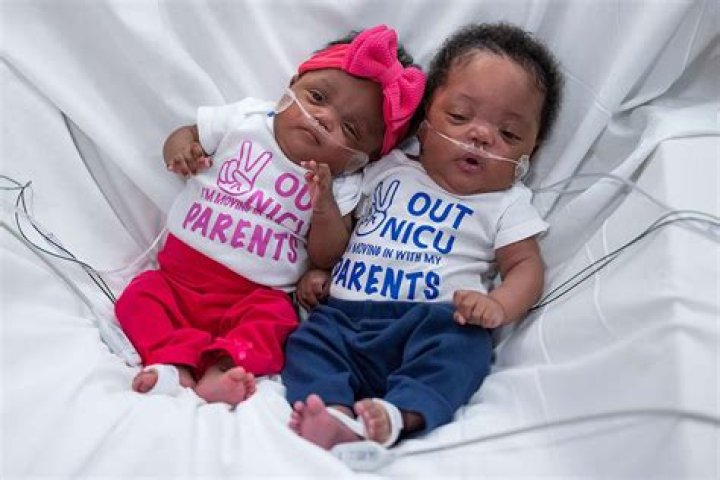 Why do stillborn babies look different?