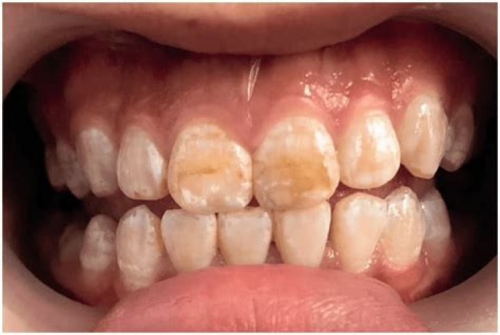Why do teeth turn brown?