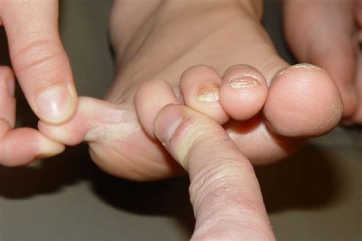 Why do toes smell like cheese?