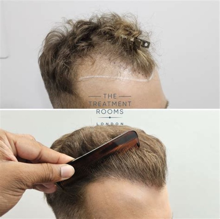 Why does hair loss start at the crown?