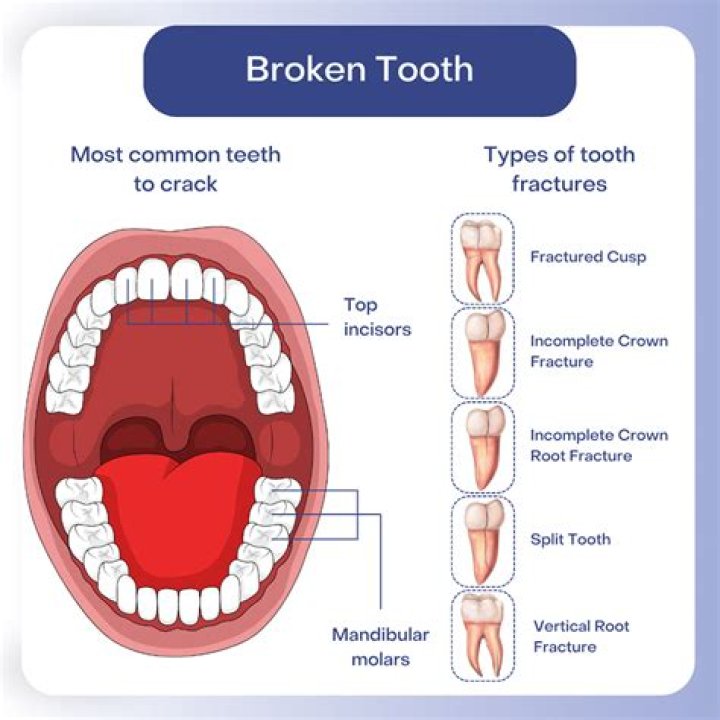Why does my cracked tooth not hurt?