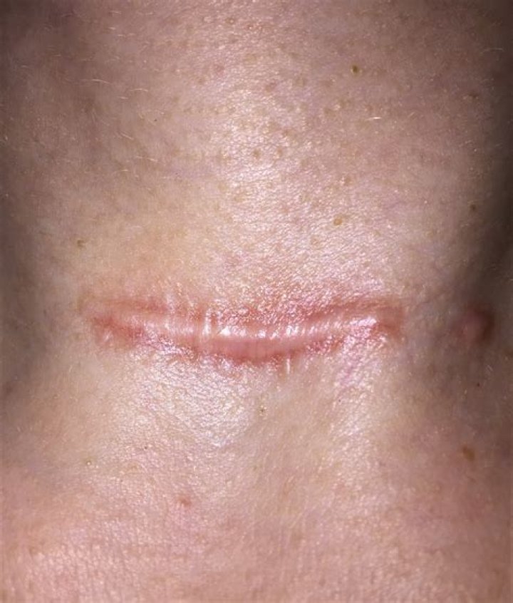 Why does my surgical scar hurt?