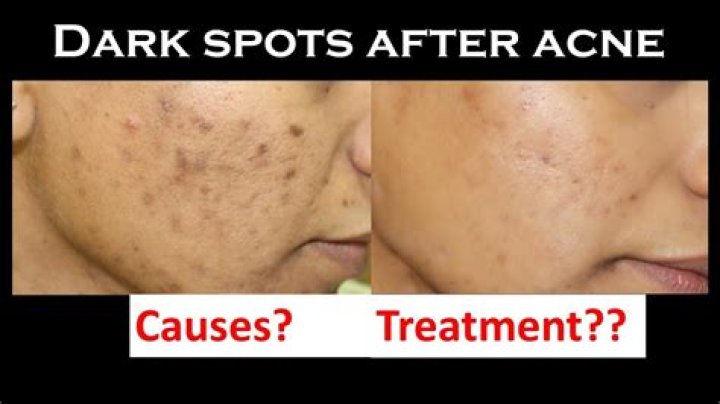 Why does skin turn dark after skincare?