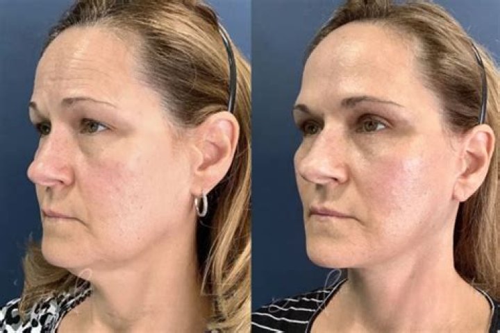 Why face looks dull after weight loss?