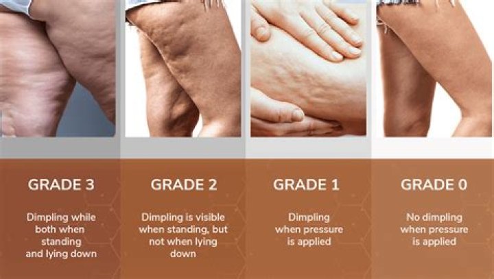 Why have I suddenly got lots of cellulite?