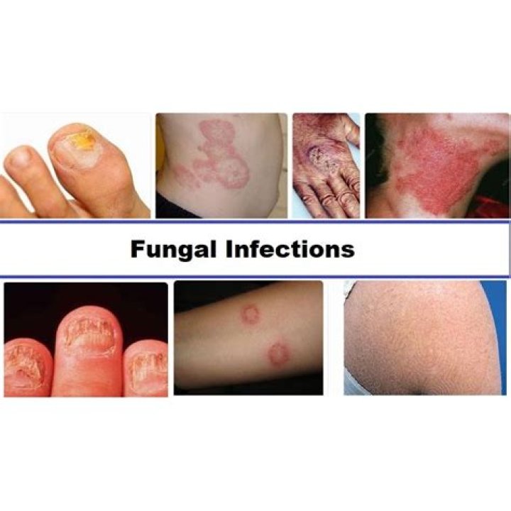Why is fungal infections so difficult to treat?