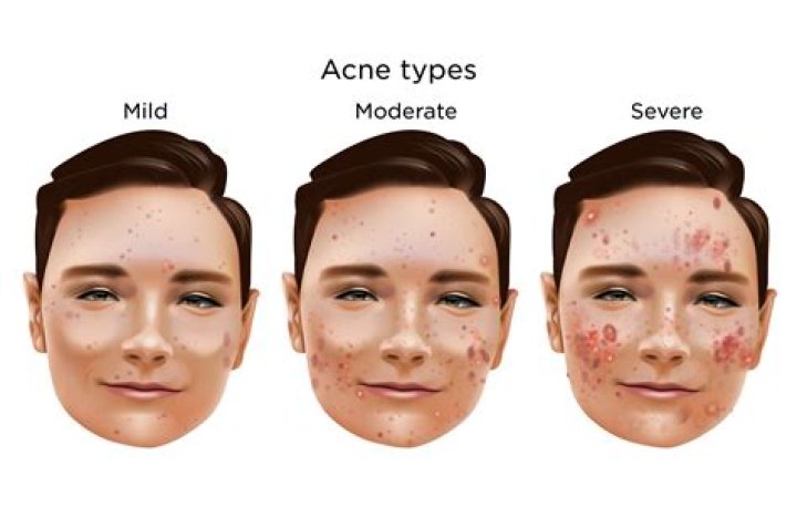 Why is my acne getting worse?