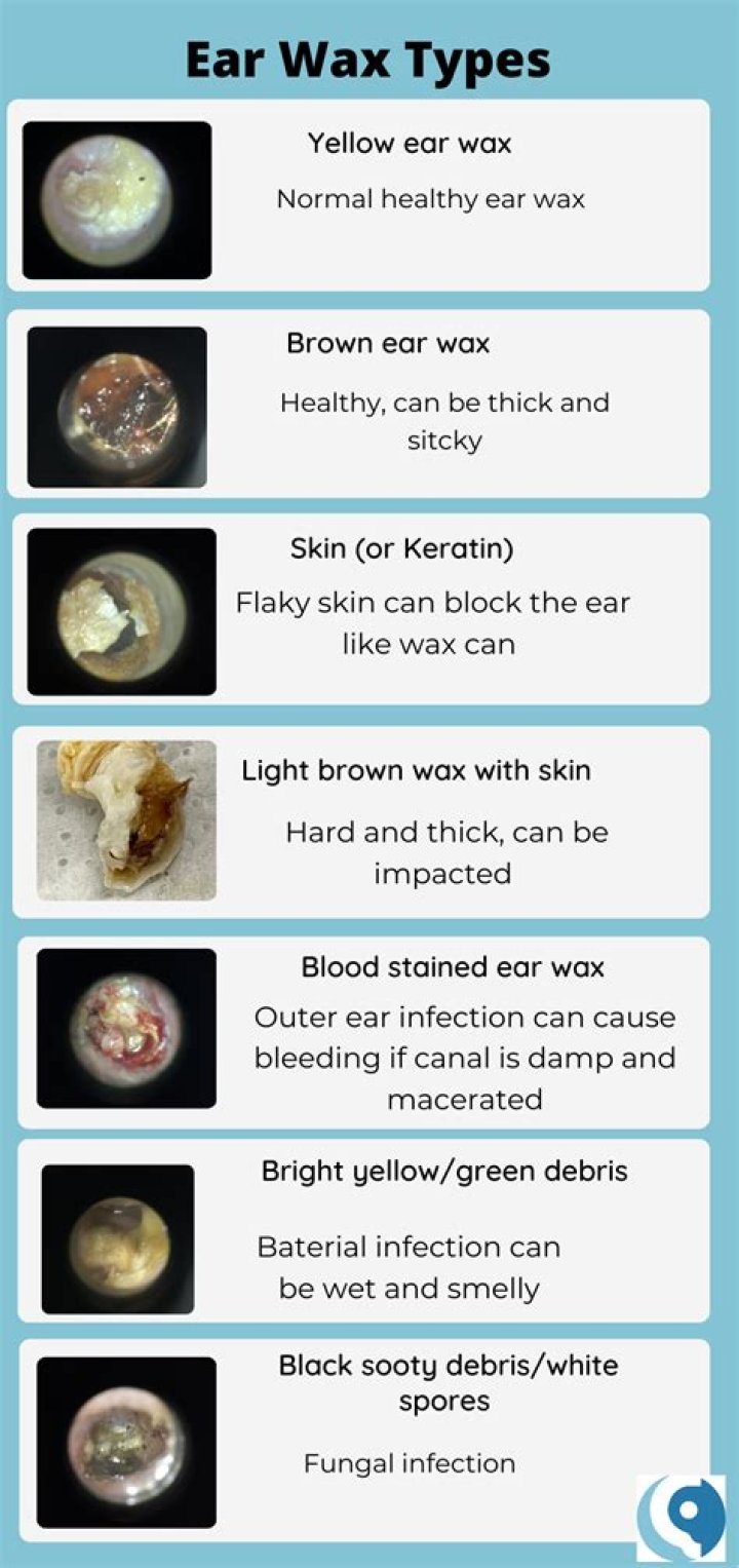 Why is my earwax white and flaky?