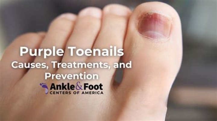 Why is my foot turning purple after sprain?