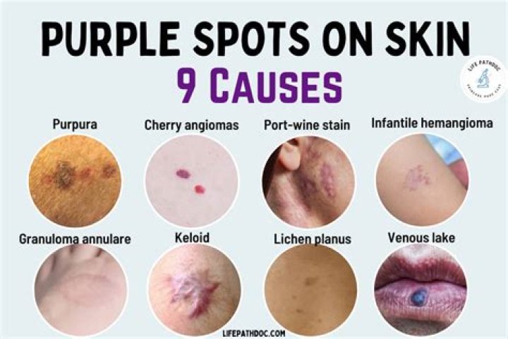 Why is my pimple purple After I popped it?
