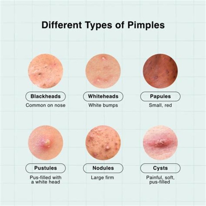 Why is my pimple stringy?