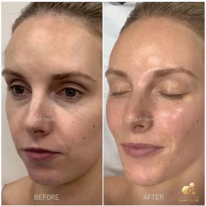 Will a chemical peel tighten neck skin?