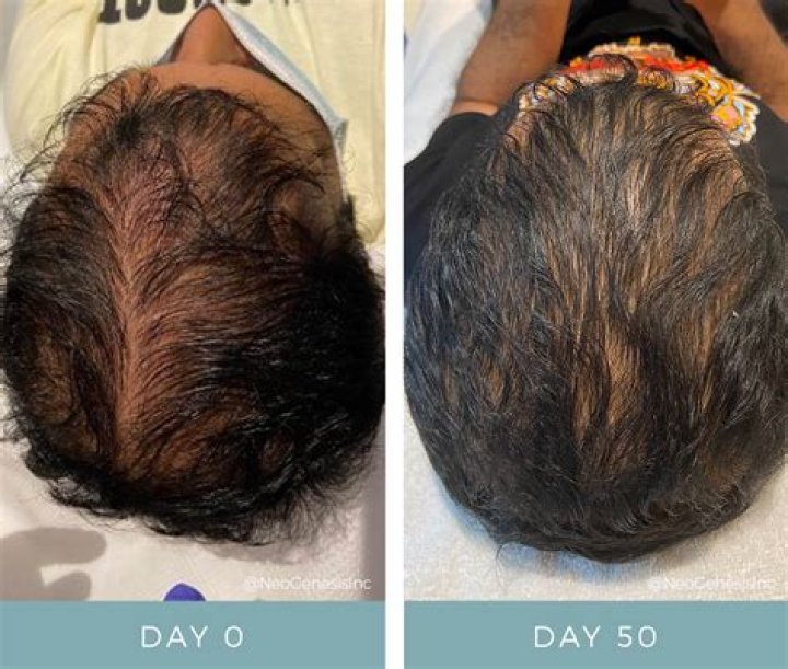 Will hair grow back after chemical damage?