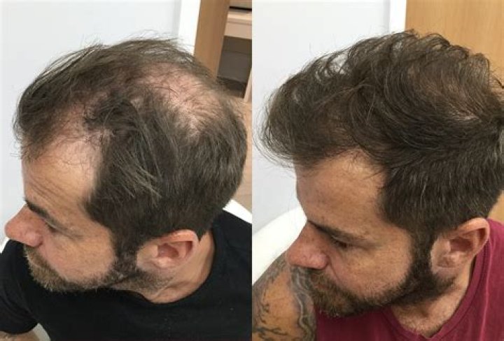 Will hair grow back after quitting nicotine?