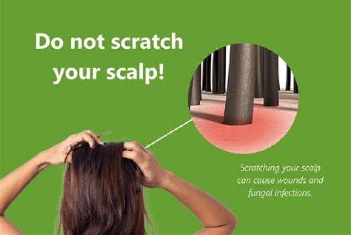 Will shaving my head get rid of dandruff?